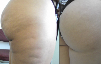 Note the skin texture and cellulite improvement with UltraSmooth