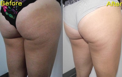 Note the skin texture and 'cottage cheese' improvement with UltraSmooth