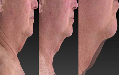 Before and after at one 20-minute bilateral UltraSlim treatment