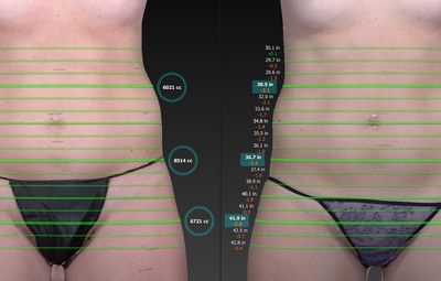 Kristen lost 1,336cc of fat in two weeks with 3 UltraSlim treatments
