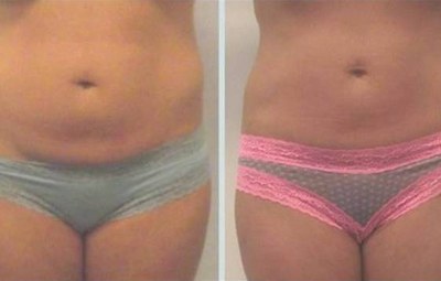 Before and after 3 UltraSlim treatments in Altamonte Springs, Florida