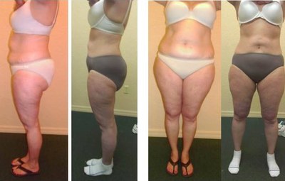 Lost 30 pounds with 12 UltraSlim treatments