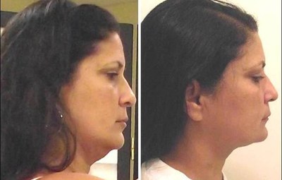 45 year-old with two 20-minute UltraSlim treatments