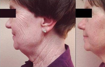 75 year-old with four 20-minute UltraSlim Treatment