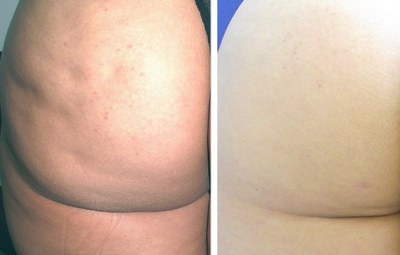 Beth enjoyed dramatic cellulite improvement with UltraSmooth