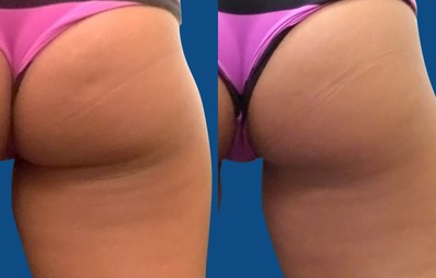 Close-up of personal trainer who was thrilled after UltraSmooth