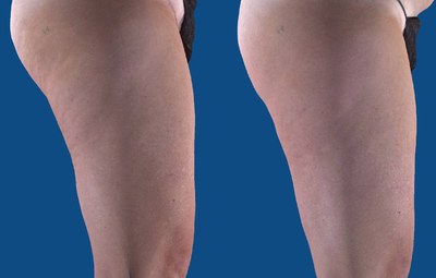 Hallee had one UltraSmooth series of 6 treatments over 2 weeks