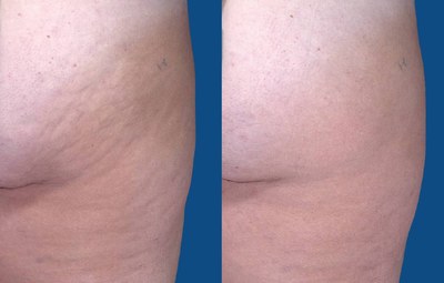 lose-up comparison of before and after UltraSmooth