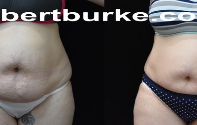 Before and after 6 weekly UltraSlim treatments